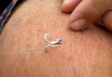 Video Pro Tips: How to Remove a Fly Stuck in Your Skin