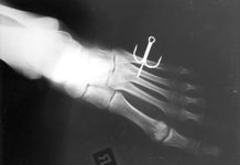 The 6 Most Common Ways Fishing Leads to Injuries, Stitches, and Emergency Room Visits